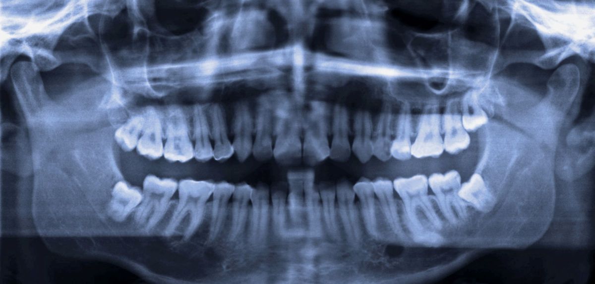 Röntgenaufnahmen mit Weisheitszähnen.